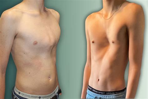 Dziecko z pectus excavatum przed i po operacji